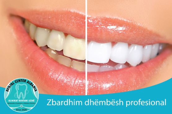 Zbardhim Profesional i dhembeve SHENGJIN nga DENTAL CENTER LEZHA